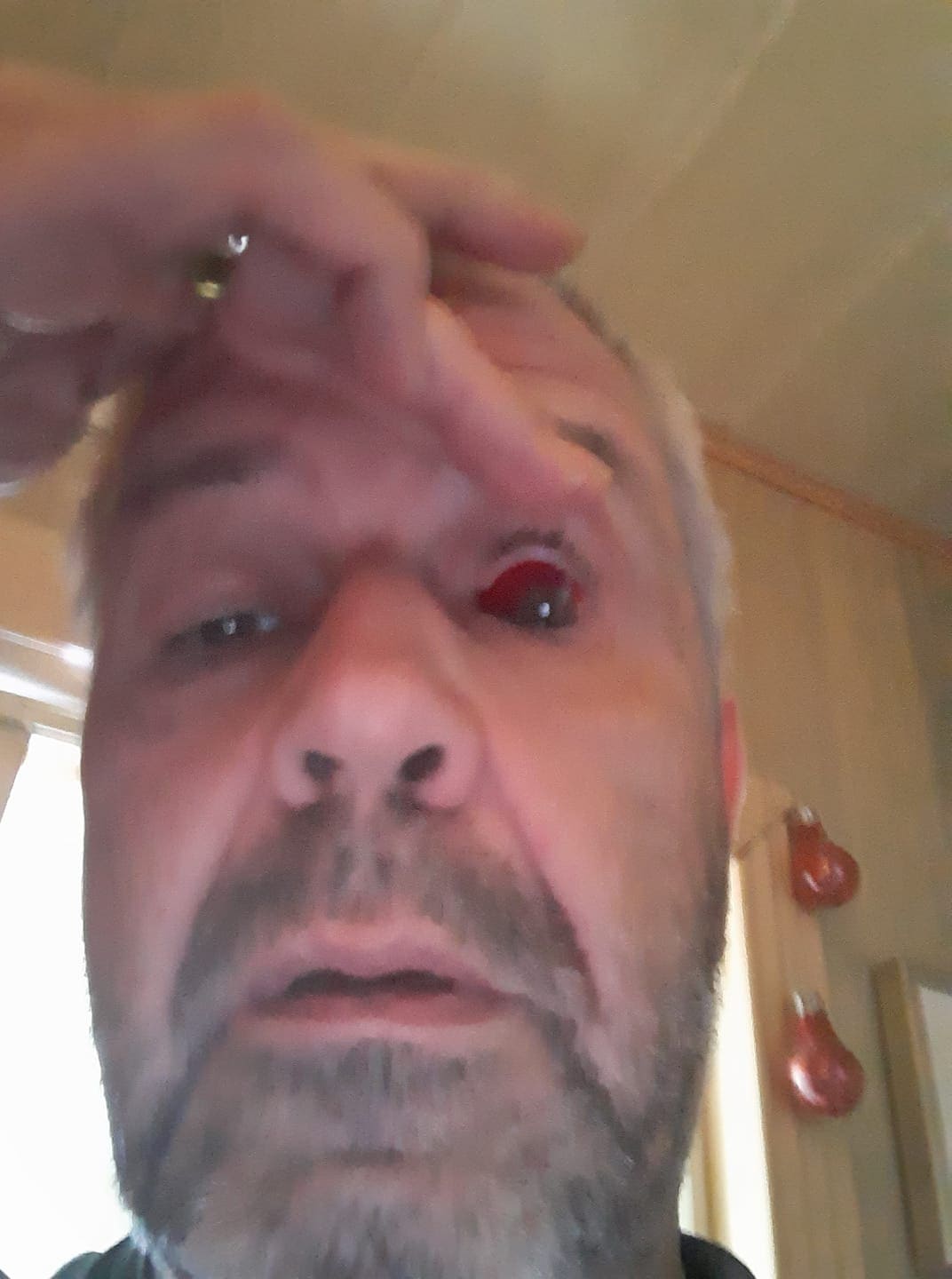 Man with bloodshot eye